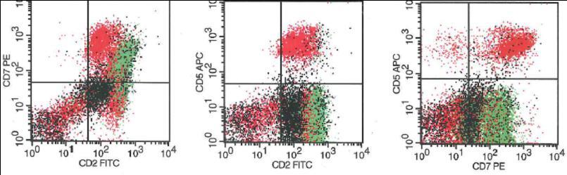 Atypical lymphoid cells show expression of CD2 (bright) and CD7 (dim) but no expression of CD5